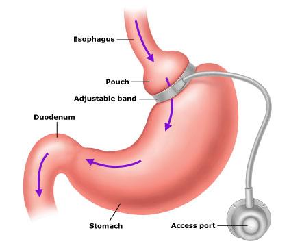 gastric banding sydney